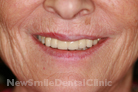 After Treatment After Treatment