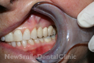 After Treatment After Treatment