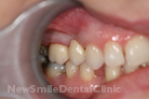 After Treatment After Treatment