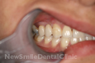 After Treatment After Treatment