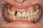Before Treatment Before Treatment