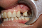 Before Treatment Before Treatment