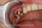 Before Treatment Before Treatment