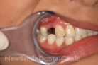 Before Treatment Before Treatment