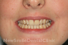 After Treatment After Treatment