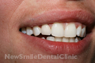 After Treatment After Treatment