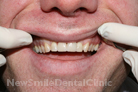 After Treatment After Treatment
