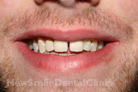 After Treatment After Treatment