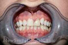 Case 13 - After Bleaching After Bleaching