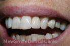 After Treatment After Treatment