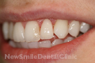 After Treatment After Treatment