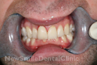 After Treatment After Treatment