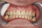 After Treatment After Treatment