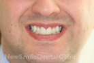 After Treatment After Treatment