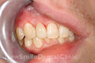 After Treatment After Treatment