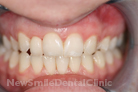 After Treatment After Treatment
