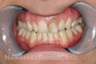 Before Treatment Before Treatment