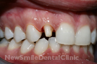 Before Treatment Before Treatment