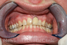 Before Treatment Before Treatment