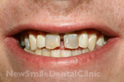 Before Treatment Before Treatment
