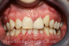 Before Treatment Before Treatment