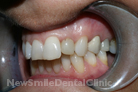 Before Treatment Before Treatment