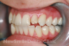 Before Treatment Before Treatment