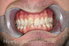 Before Treatment Before Treatment