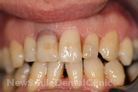 Before Treatment Before Treatment