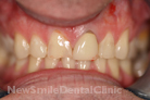 Before Treatment Before Treatment