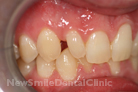 Before Treatment Before Treatment