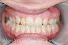 Before Treatment Before Treatment