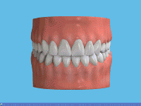 Crown Posterior Crown Posterior