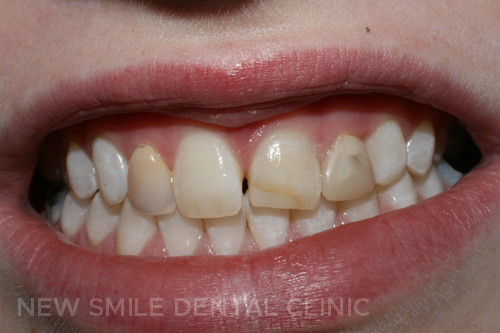 Teeth whitened