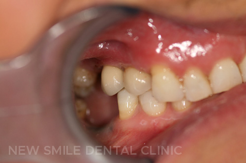 Dental Implants - after