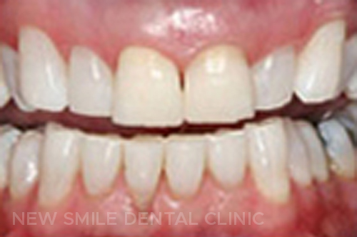 Teeth Whitening - after