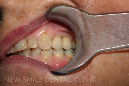 Dental Implants - after