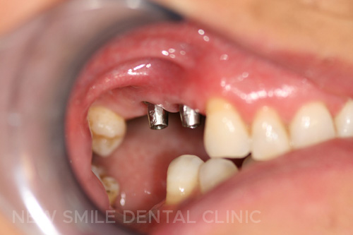 Dental Implants - before