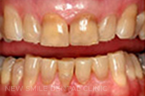 Teeth Whitening - before