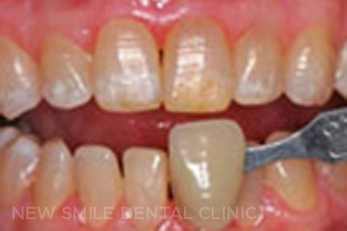 Teeth Whitening - before
