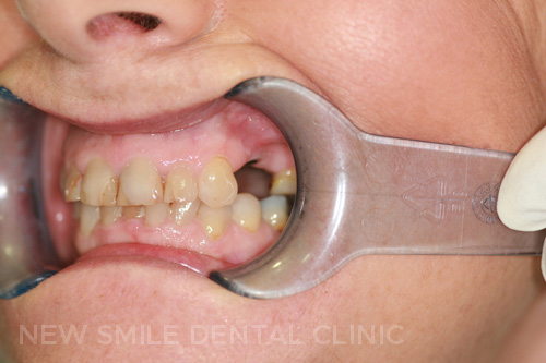 Dental Implants - before