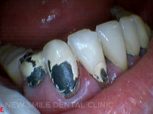 Occlusal problems in teeth