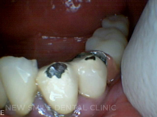 Occlusal problems in teeth