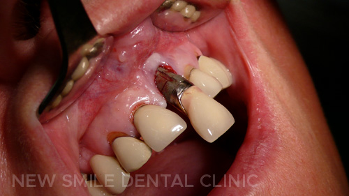 Dental implant